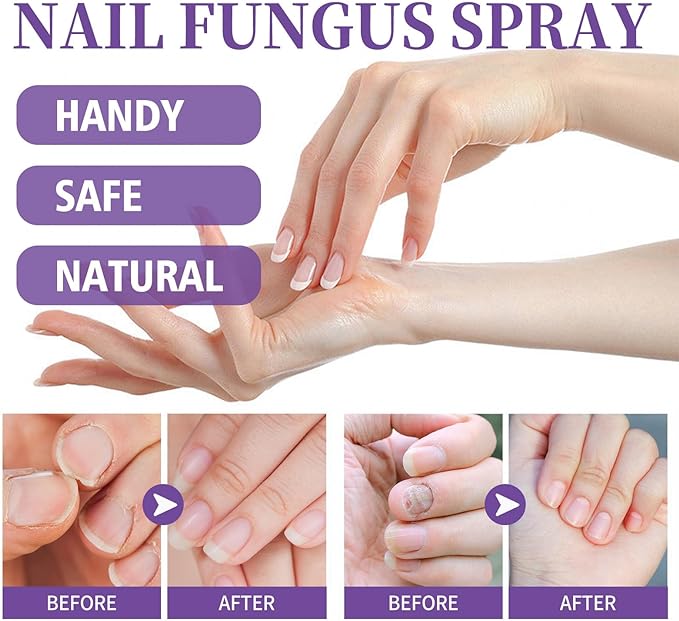 Jaysuin - Nail Fungus Spray (Original)